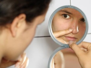cómo evitar el acné en la cara