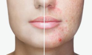 Como eliminar marcas de acne