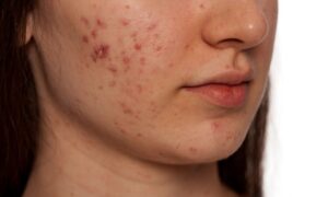 ¿Qué alimentos pueden causar acné?