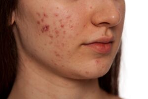 Qué alimentos pueden causar acné