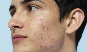 Estudio y el acné: un a relación muy cercana